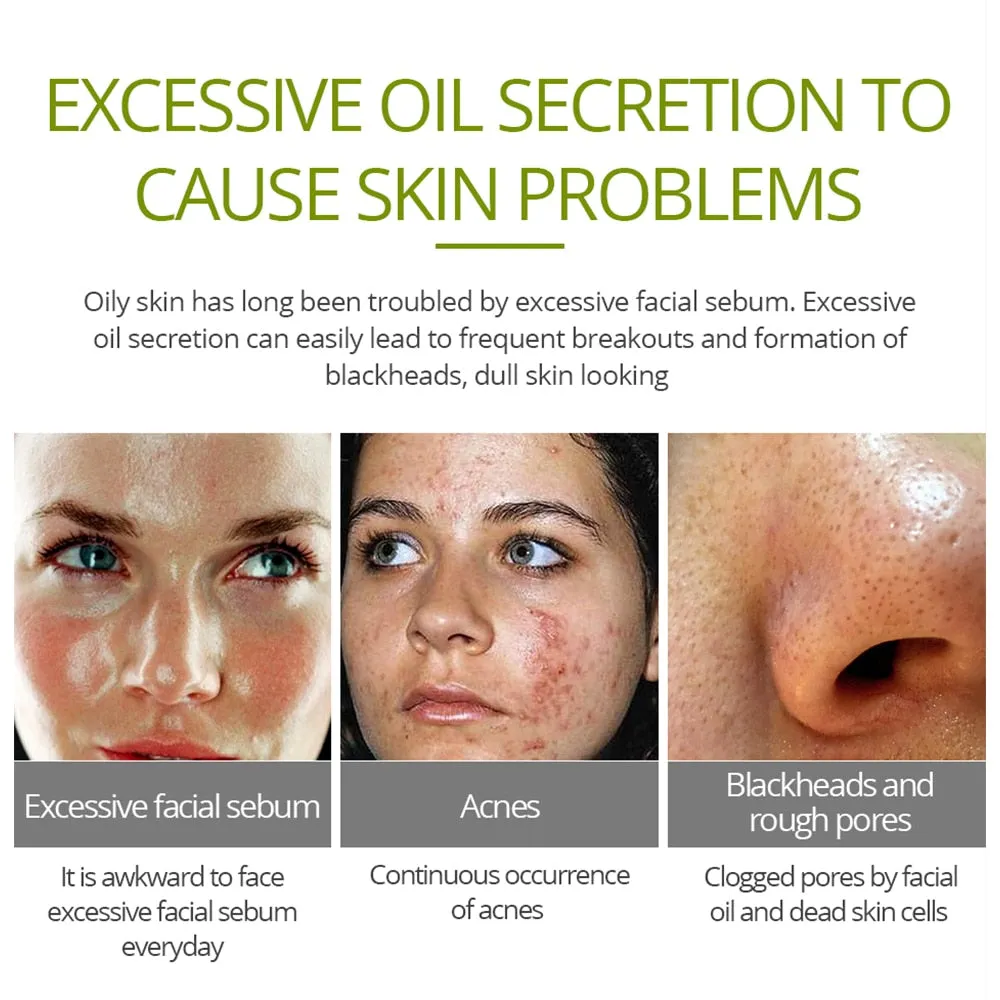 VIBRANT GLAMOUR Tea Tree Acne Cream Anti-acne Print Face Cream Remover Acne  Treatment Facial Eliminates Oil Control Skin Care